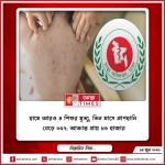 হামে আরও ৪ শিশুর মৃত্যু, তিন মাসে প্রাণহানি বেড়ে ৬৫২; আক্রান্ত প্রায় ৮৬ হাজার